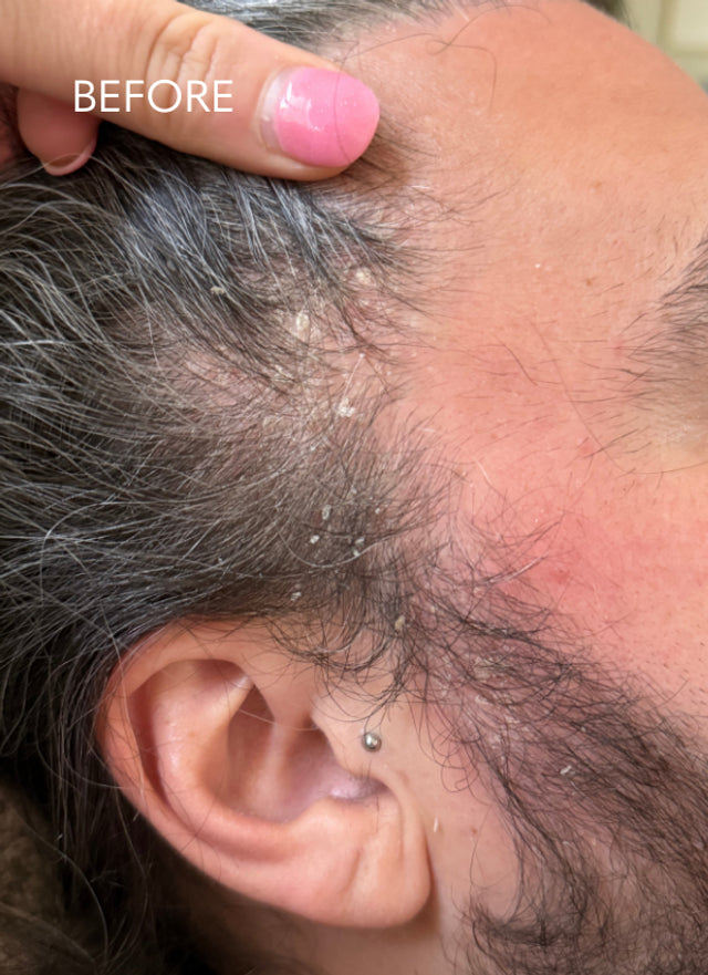 La Biosthetique Purifying Dandruff Shampoo before use. This perfume-free shampoo gently removes dandruff, soothes irritated scalps, restores balance, and supports healthy hair growth. La Biosthetique Australian stockist. Free Shipping for orders over $350. Shipping only in Australia. Shop now!
