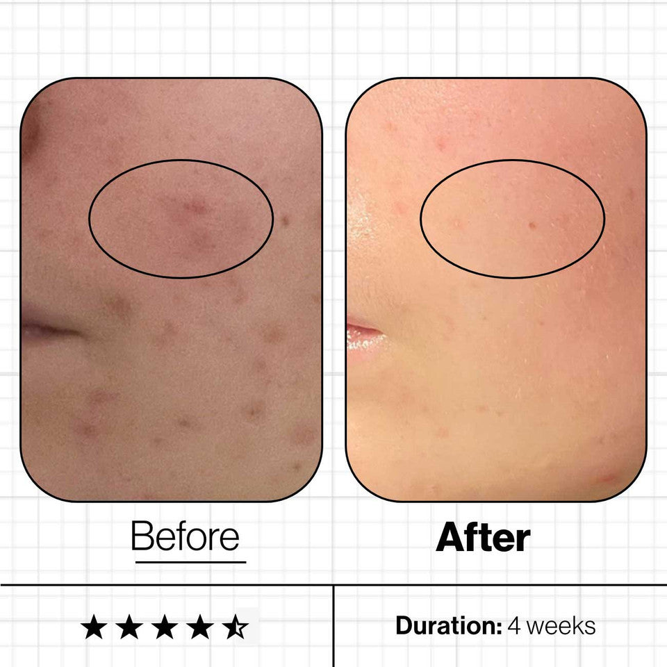 Advanced Nutrition Programme's Skin Clear Biome™ Before and After 