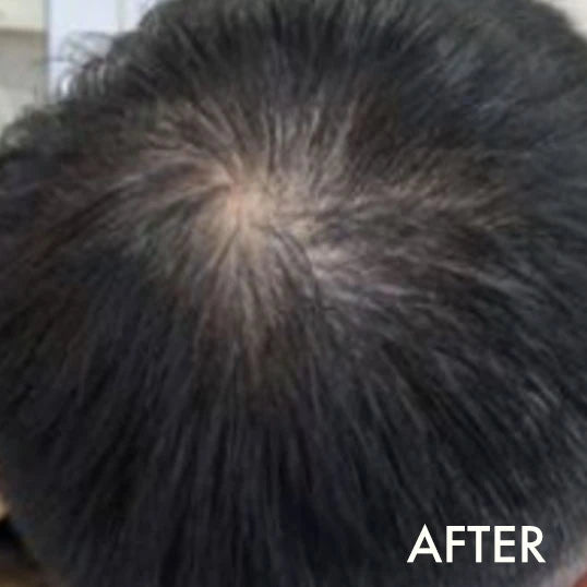 After using La Biosthetique Methode Regenerante range for hair loss and age-related thinning.